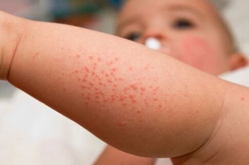 Allergie chez un enfant comme symptôme de la présence de vers